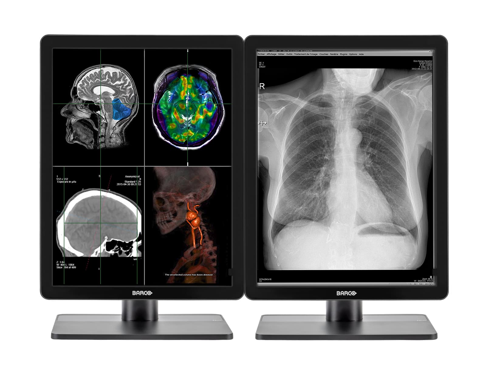 Complete PACS General Radiology Station | Barco Display HP Workstation